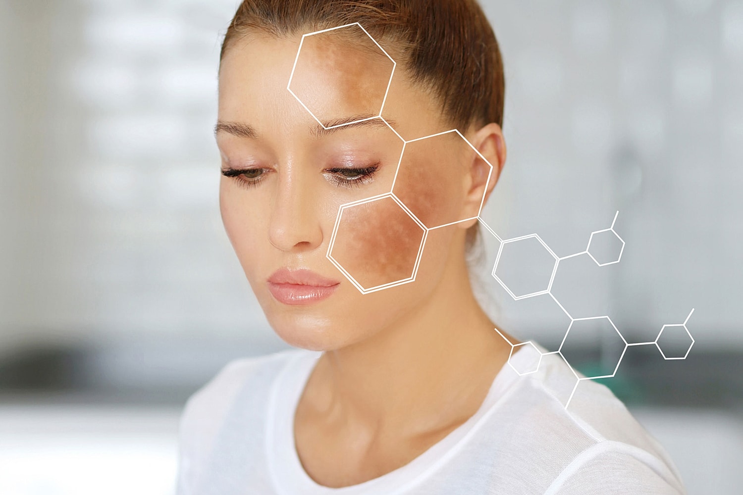 4 Things You Should Know About Melasma