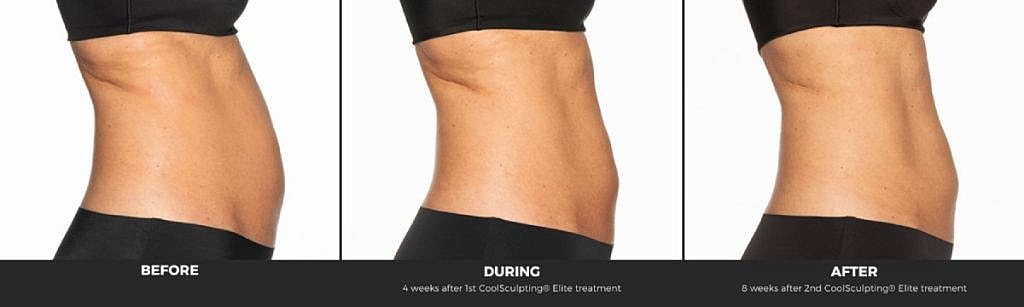 CoolSculpting results: before, during, and after.