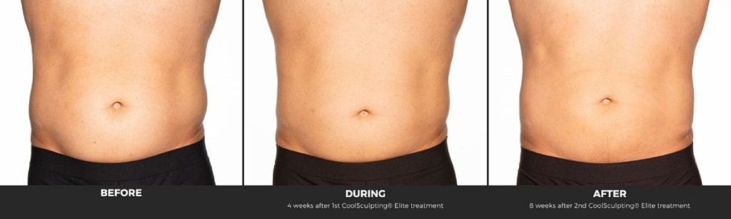 CoolSculpting results: Before, during, and after treatment.